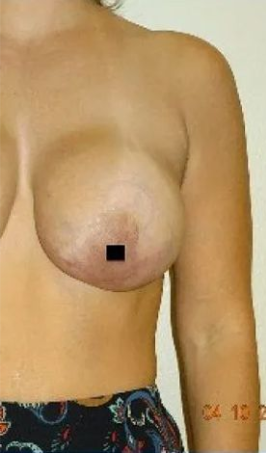 Woman's bare torso with one breast visible; date stamp in corner.