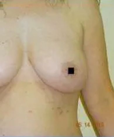 Woman's bare chest; a small black square covers the right nipple.