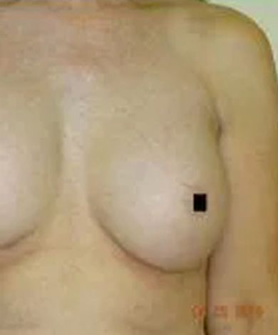 Chest and shoulder of a person, with a breast visible and a black square covering a nipple.