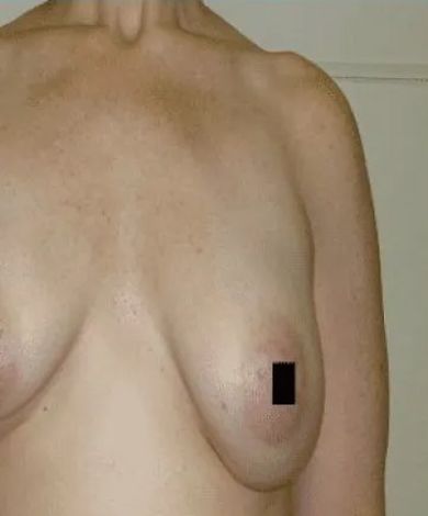 A person's torso and chest; a black square obscures the nipple.