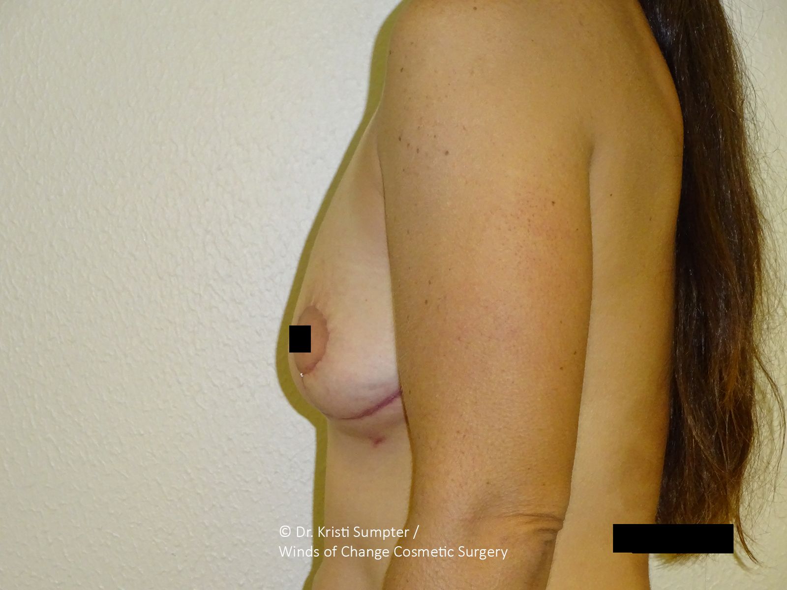 Profile view of a bare torso. The left breast is visible with a dark-colored nipple. Light skin.