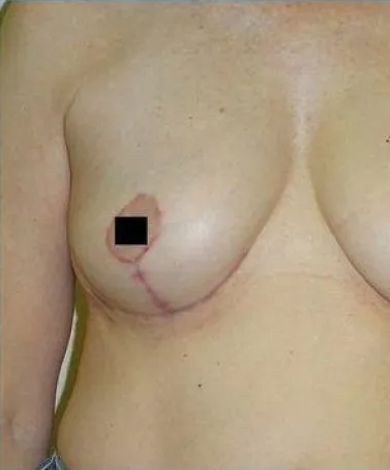 Torso with visible breast surgery scar. One nipple is covered. Skin tone is light.