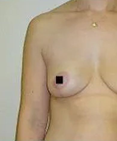 Torso of a person with a bare chest; nipple covered by a black square.