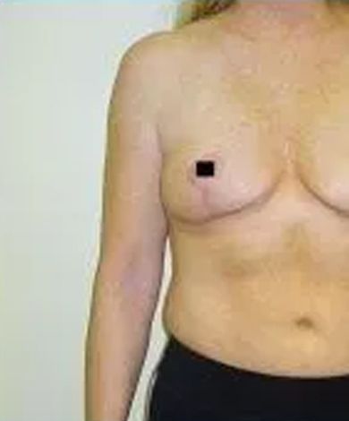 Torso of a person, the right nipple is obscured with a black square.