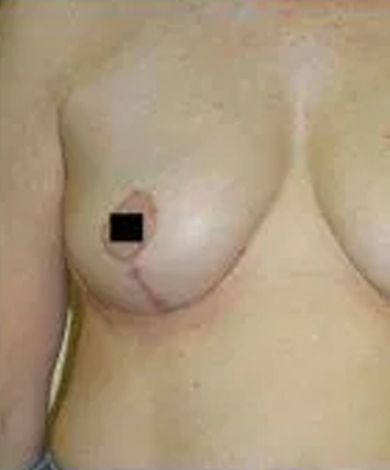 Close-up of a person's torso. Visible breast with a scar and blocked nipple.