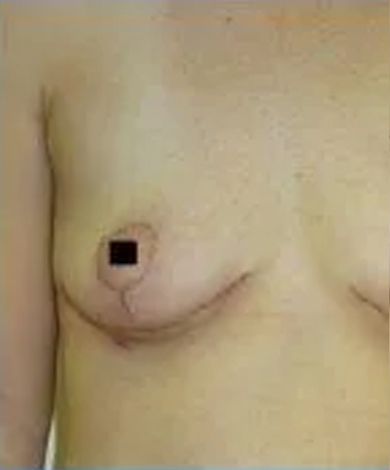 Chest with surgical scars, one nipple covered with a black square.