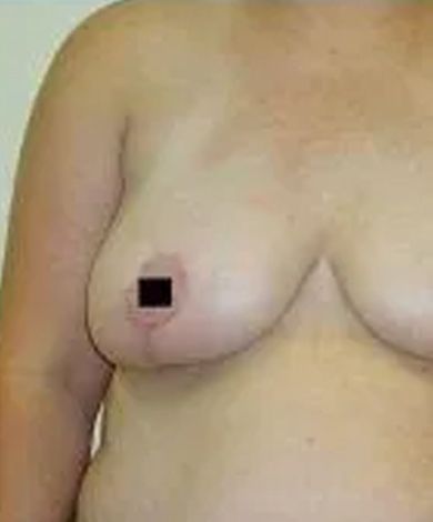 Naked torso with a black square covering the nipple of one breast.