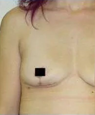 Upper torso of a person with a surgical scar on the left breast, nipple obscured.