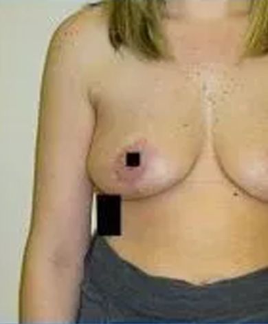 Torso of a person with bare breasts, small black squares covering the nipple and lower breast area.
