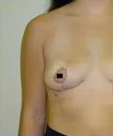 Woman's chest, showing a breast with a surgical scar, nipple covered by a black square.