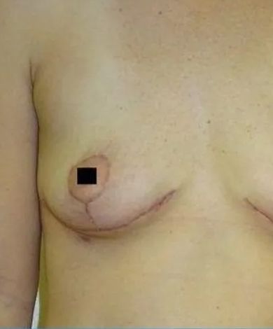 A person's chest with surgical scars and a black box obscuring the nipple.