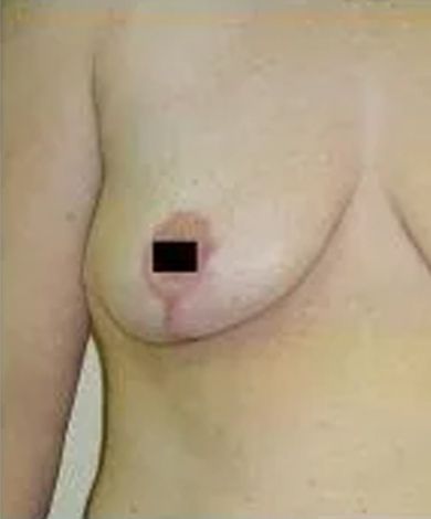 A person's torso and right breast, skin-toned, with a black square covering the nipple.