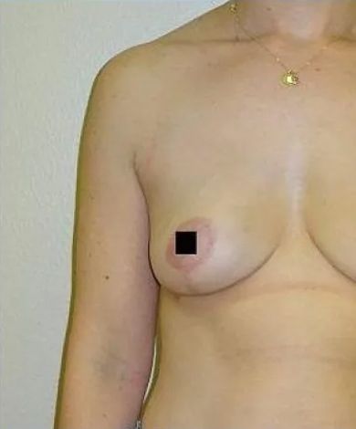 A person's torso, featuring the chest and arm. The right nipple is obscured by a black square.