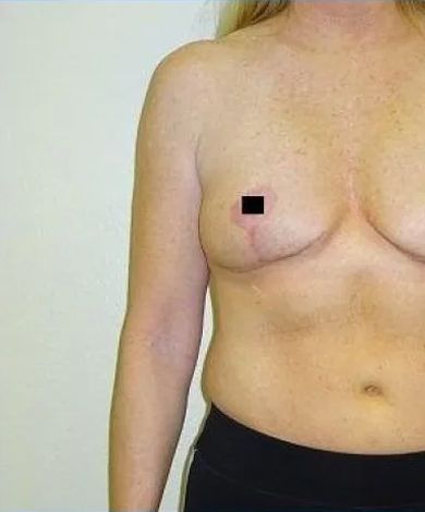 Woman's torso, post-surgery. Scarring and a small square block out one nipple. Wearing dark athletic shorts.