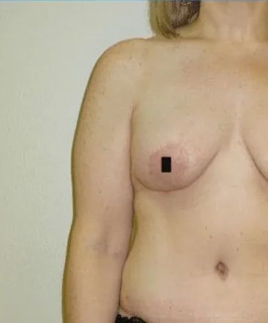 Torso of a person with a black square covering a nipple.