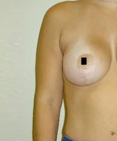 Woman's torso, arm raised slightly. Right breast visible with nipple covered by a black square.