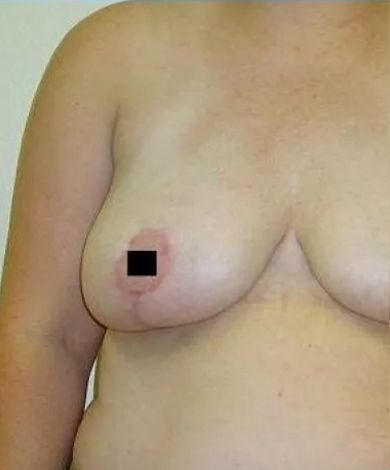 A woman's bare chest; a darkened area on the nipple is obscured by a black box.