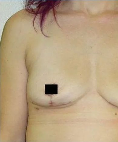 Chest of a person, post-surgery. Skin is light with a scar beneath the right nipple, which is blocked out.