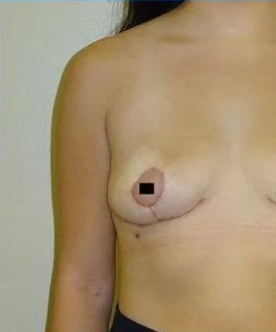 A person's torso with a breast; nipple area blacked out; visible scar from surgery.