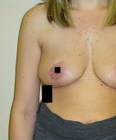 Woman's torso, breasts visible, with black squares obscuring nipples and lower area.