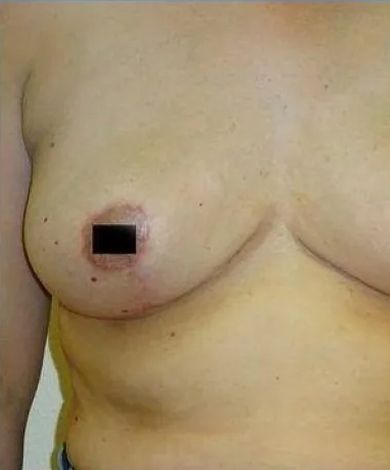 A person's torso with a breast, the nipple area blacked out and showing signs of redness or irritation.