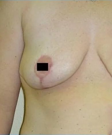 A person's torso, the right breast is visible with an obscured nipple. Skin is light-toned.