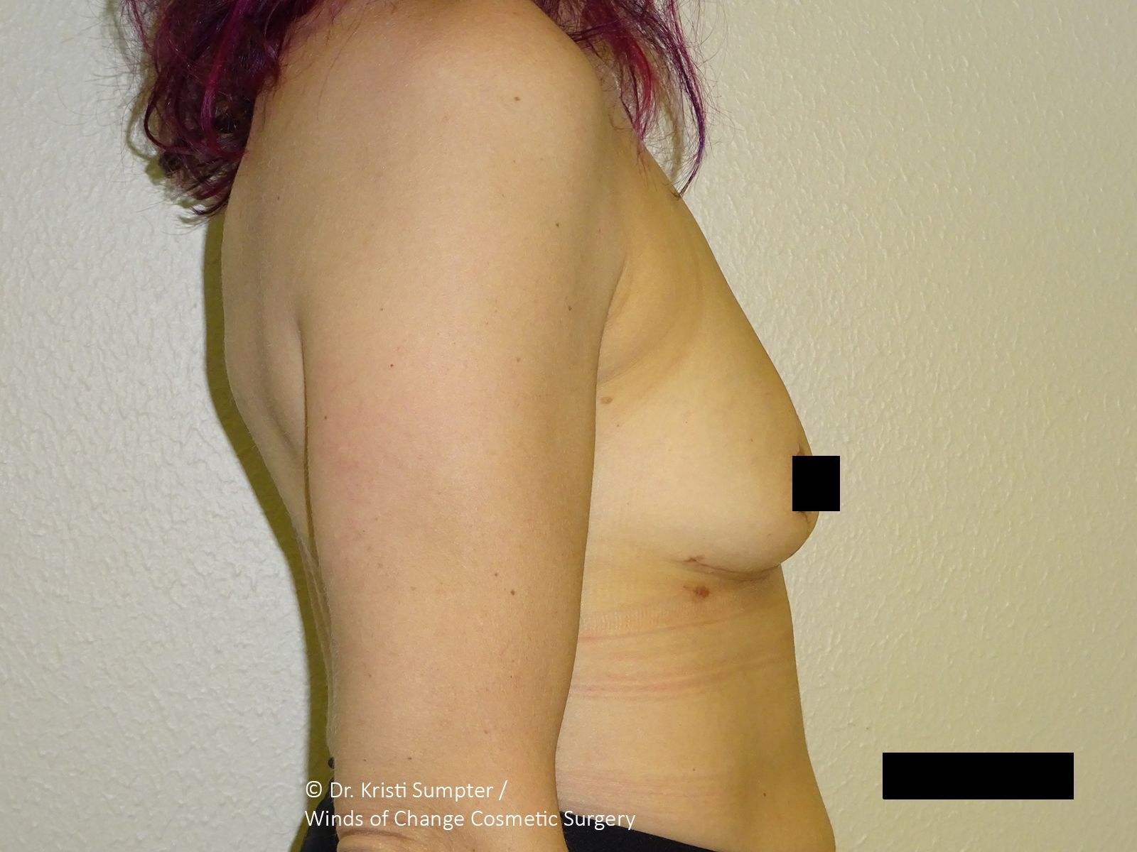 Side view of a person's torso and arm against a plain wall; a breast is visible.
