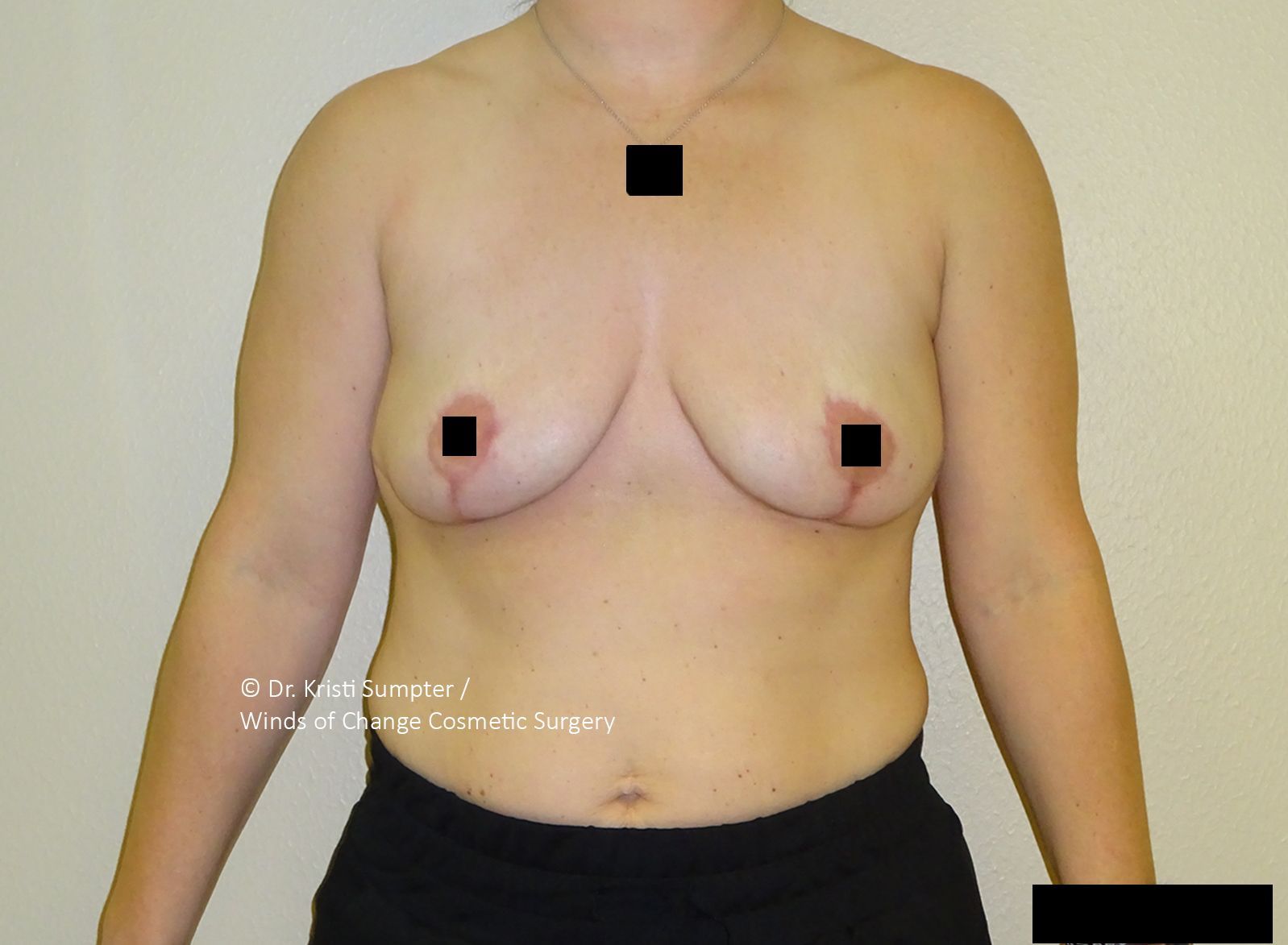 Naked torso of a person with breasts, nipples covered by black squares. Person is standing against a light-colored background.