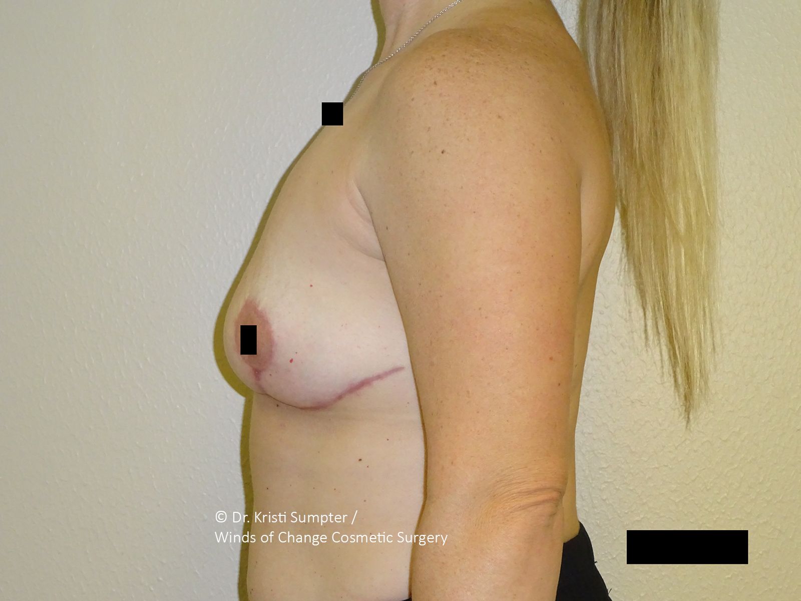 Side view of a woman's torso, showing post-surgery breast with scar.