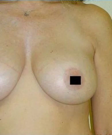 Close-up of a person's chest, showing both breasts. The right nipple is obscured by a black box.