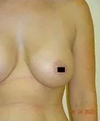 Torso of a person with a breast, nipple area obscured by a black square. Skin tone is light.