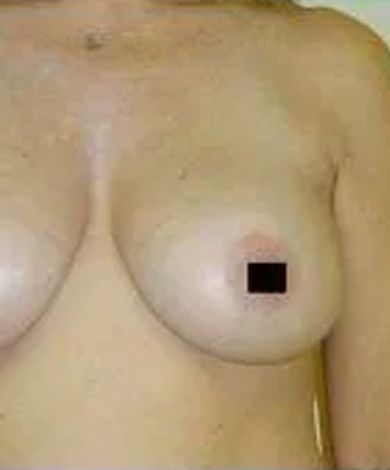 Torso with breasts; areola obscured by a black square.