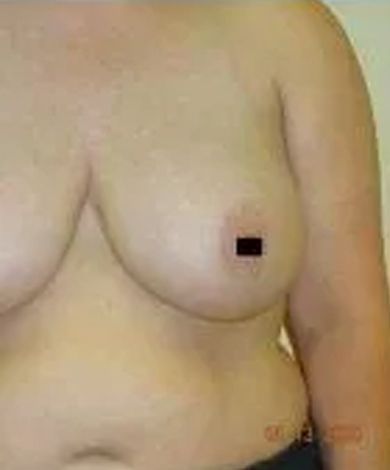 Torso of a person with a breast, nipple covered by a black rectangle.