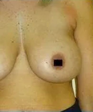A person's torso with a breast; the nipple is obscured by a black square.