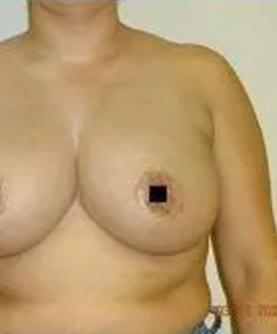 A person's torso with two breasts. The right nipple is obscured by a black square.