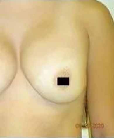Close-up of a person's bare chest, with a small black square covering the nipple.