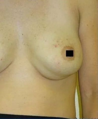 Close-up of a person's torso, focusing on a breast with a small, black square covering the nipple.