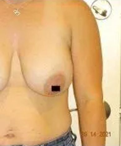 Torso of a person with bare breasts, partially obscured nipple. The person holds their arm.
