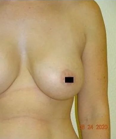 Upper torso of a person; one breast with a small black square covering the nipple.