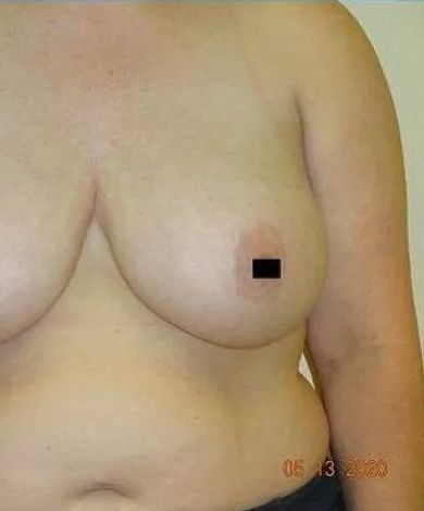 A person's torso, close-up, with breast and partially visible abdomen. The nipple is obscured. Skin is light-toned.