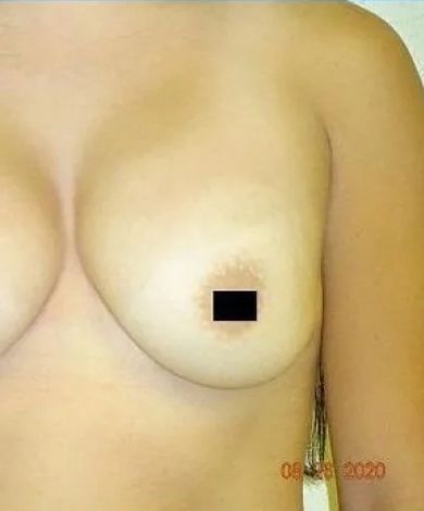 Torso of a person with a breast, nipple area obscured by a black square. Brown skin, neutral background.