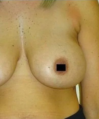 Close-up of a person's torso, with breast and chest visible; skin is light-toned.