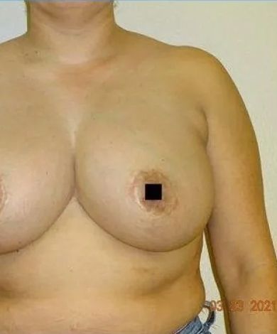 Torso with breasts, right nipple obscured by a black square. Skin is tan.