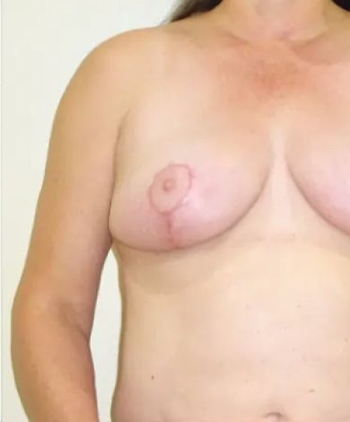 A person's torso, featuring breasts, with visible scars and discoloration on the left breast and chest.