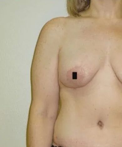 Torso of a person with a marked nipple on the right breast, against a neutral background.