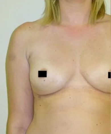 Woman's torso, breasts visible, nipples obscured. Blonde hair, light skin, plain background.