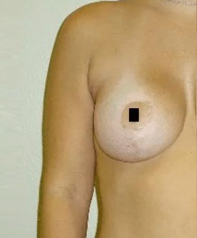 Woman's chest, right breast visible. Skin tone is light. Nipple covered by black square.