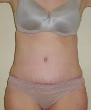 Woman wearing bra and underwear; front view of torso, showing the midriff and upper thighs.