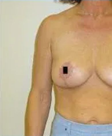 Woman's torso with a breast; a black square obscures the nipple.