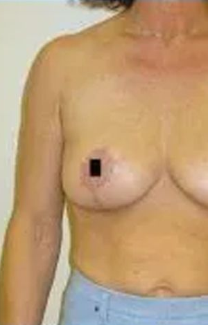 Woman's torso with a breast; a black square obscures the nipple.
